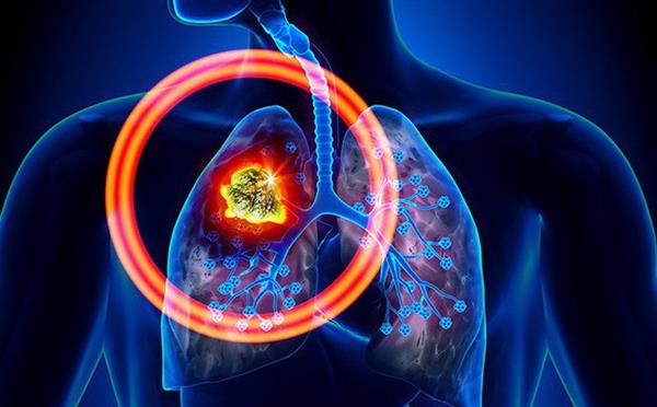 Những triệu chứng mà hầu hết dân văn phòng đều mắc nhưng cũng có thể là dấu hiệu ung thư Phổi
