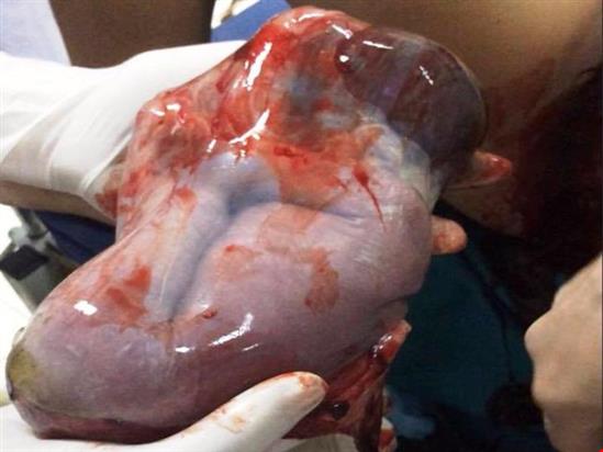 Kinh ngạc em bé xứ Nghệ ra đời trong bọc ối còn nguyên