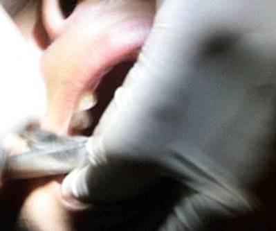 Bị phản bội, nữ nha sĩ nhổ sạch răng người yêu