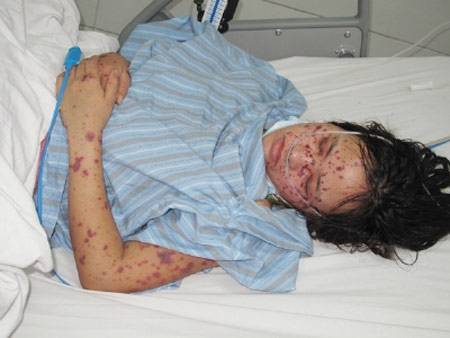 5 tỉnh thành xuất hiện bệnh não mô cầu