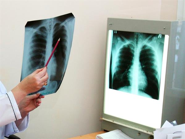 Chẩn đoán sớm bệnh lao qua hơi thở