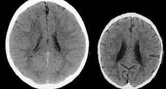 Đây là bộ não của 2 đứa trẻ và lý do làm nên sự khác biệt sẽ khiến tất cả mọi người phải giật mình