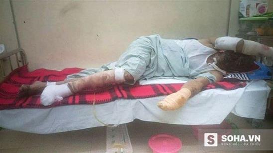 Nổ gas kinh hoàng: Con bỏng phổi tự chở cha đi cấp cứu