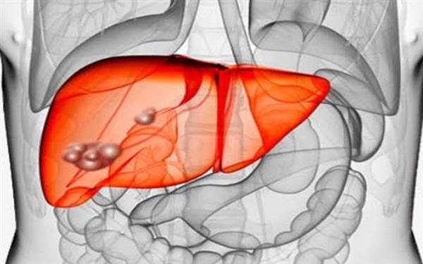 10 tác nhân khiến gan nhiễm mỡ và dấu hiệu bệnh gan