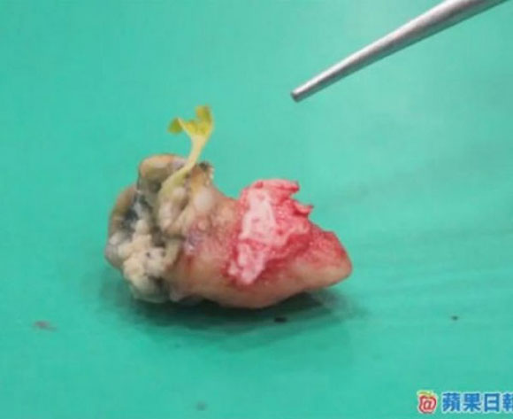 Giật mình cây ổi mọc trên răng