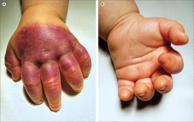 Giải mã căn bệnh siêu hiếm, lần đầu ghi nhận ở Việt Nam