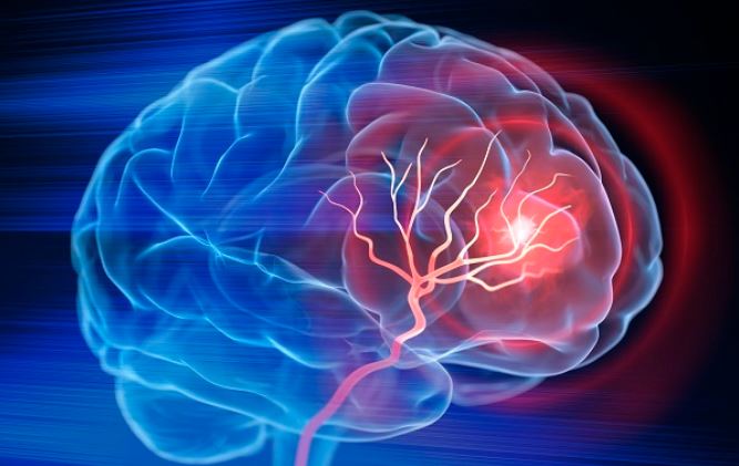 Sau cơn thiếu máu não thoáng qua, 72 giờ đầu cần làm gì để tránh đột quỵ não?