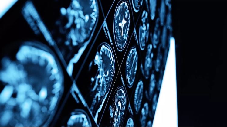Lần đầu tiên trên thế giới sử dụng AI hỗ trợ loại bỏ khối u não tại Anh