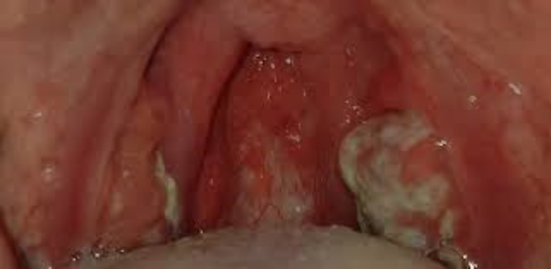 Bệnh bạch hầu lây truyền thế nào?