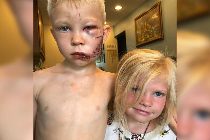 Bé 6 tuổi khâu 90 mũi vì cứu em gái khỏi chó cắn