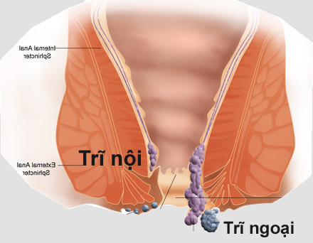 Cảnh báo 30 - 50% người Việt mắc căn bệnh để lâu dễ thành ung thư