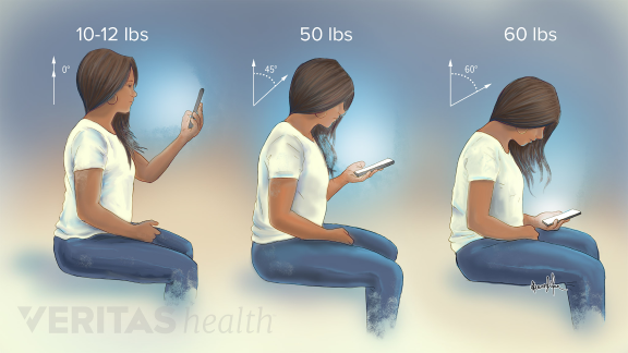 Tự nhiên đau cổ, vai: Bạn có đang dùng điện thoại thông minh không?