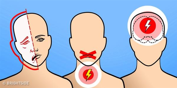 Dấu hiệu cảnh báo tình trạng đột quỵ