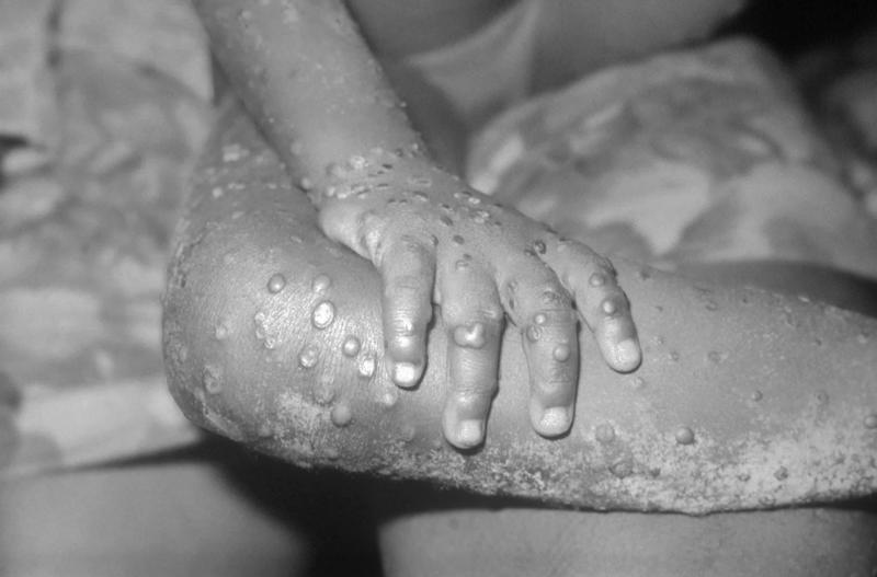 Quốc gia đầu tiên trên thế giới cách ly bắt buộc 21 ngày với bệnh nhân đậu mùa khỉ