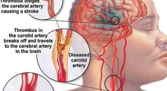 Dấu hiệu nhận ra người sắp bị đột quỵ