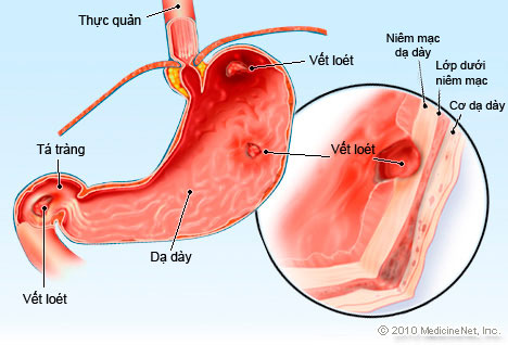 Cảnh giác với nguy cơ ung thư do viêm loét dạ dày