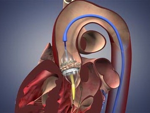 Nga: Ghép thành công mẫu van tim nhân tạo mới nhất thế giới