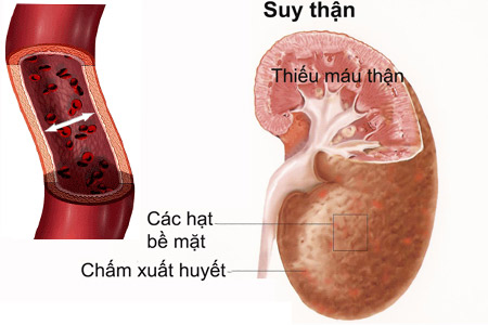 Khi đi tiểu có những dấu hiệu sau có thể thận bạn sắp 