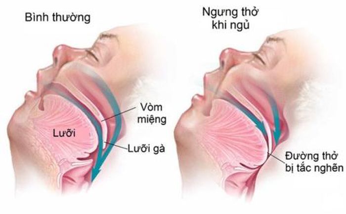 Nhóm người dễ mắc hội chứng ngừng thở khi ngủ và những biến chứng nguy hiểm