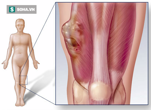 Những triệu chứng cảnh báo bệnh ung thư xương cần đi khám ngay