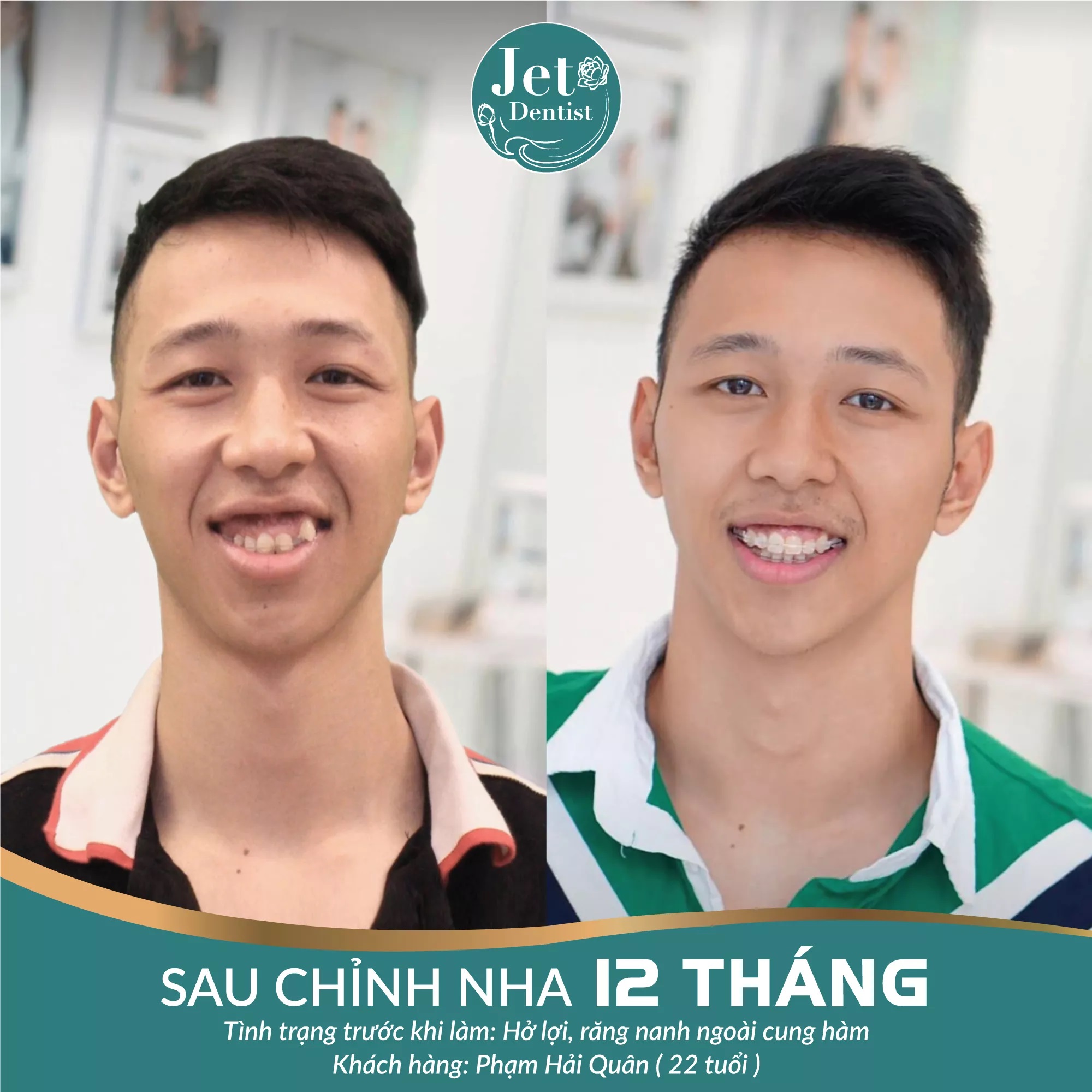 Nha khoa thẩm mỹ Jet Dentist: Niềng răng mắc cài sứ là gì?