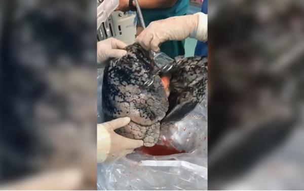 Video gây sốc lá phổi đen như than của người đàn ông nghiện thuốc lá 30 năm