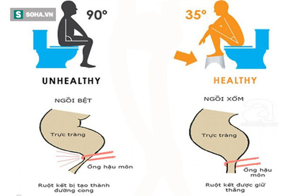 Đây mới là tư thế ngồi khi đi vệ sinh tốt nhất cho sức khoẻ
