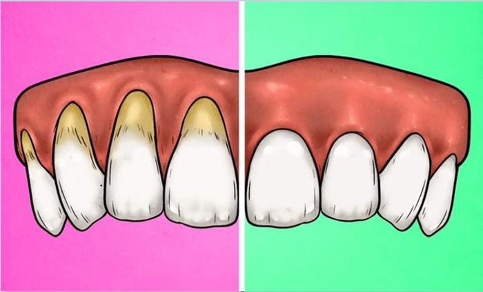 4 dấu hiệu cảnh báo bạn đang đánh răng quá kỹ và cách khắc phục để giữ răng khỏe