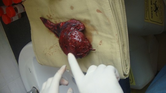 Bóc u phổi khổng lồ cho bệnh nhân hút thuốc lá