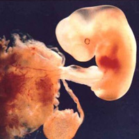 Phát hiện ca “thai trong thai” hiếm gặp