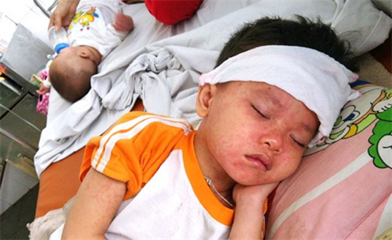 Tất cả những điều cần biết về bệnh sởi