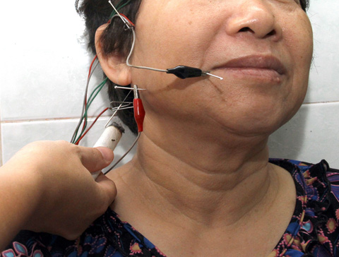 Méo mồm, liệt mặt vì hay thức khuya