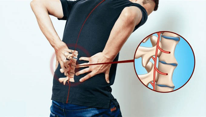 Viêm cột sống dính khớp: Bệnh hiếm gặp, nguy hiểm, khó chữa trị