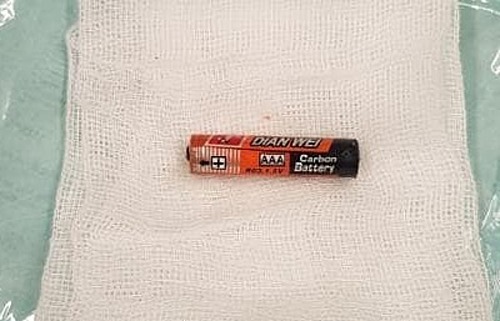 Bé trai 4 tuổi suýt thủng dạ dày do nuốt pin