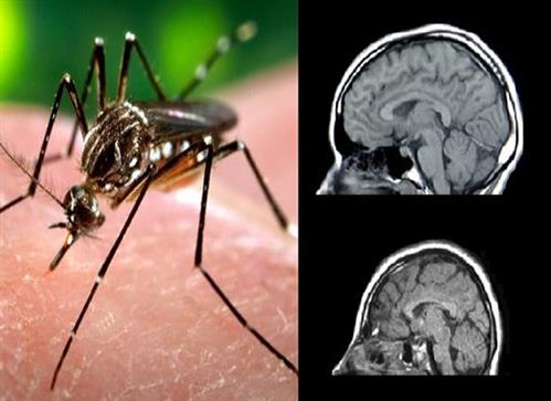 Virus Zika 